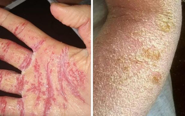 topical steroid hand arm