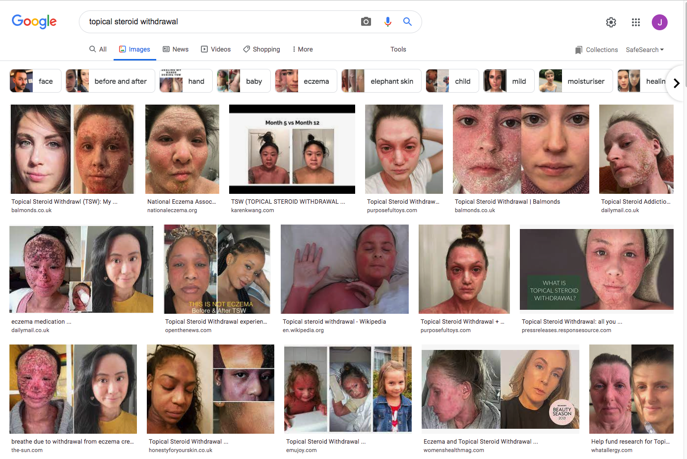 topical steroid withdrawal google image