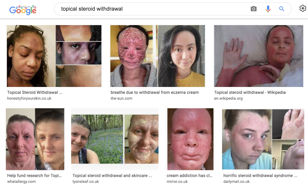 topical steroid withdrawal google images