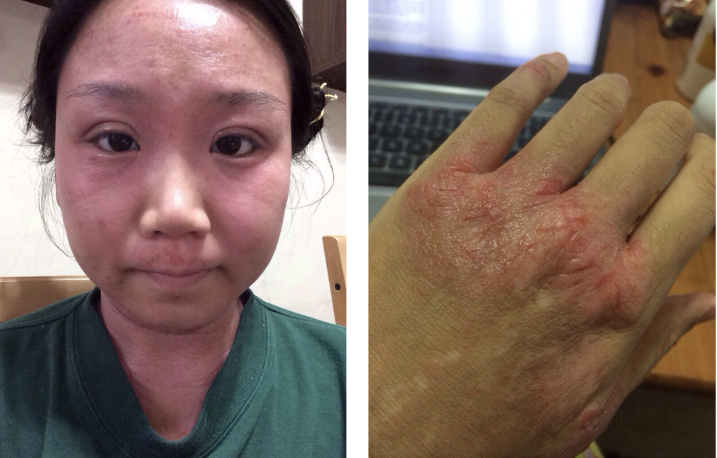 stage 1 tsw - inflammation