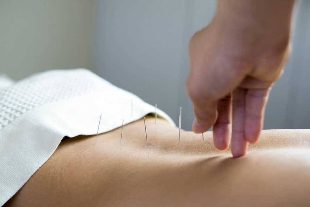 acupunctue for tsw