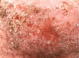 topical steroid withdrawal