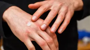 topical steroids side effects