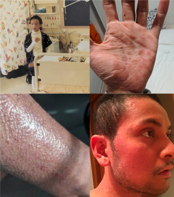 jason topical steroid withdrawal