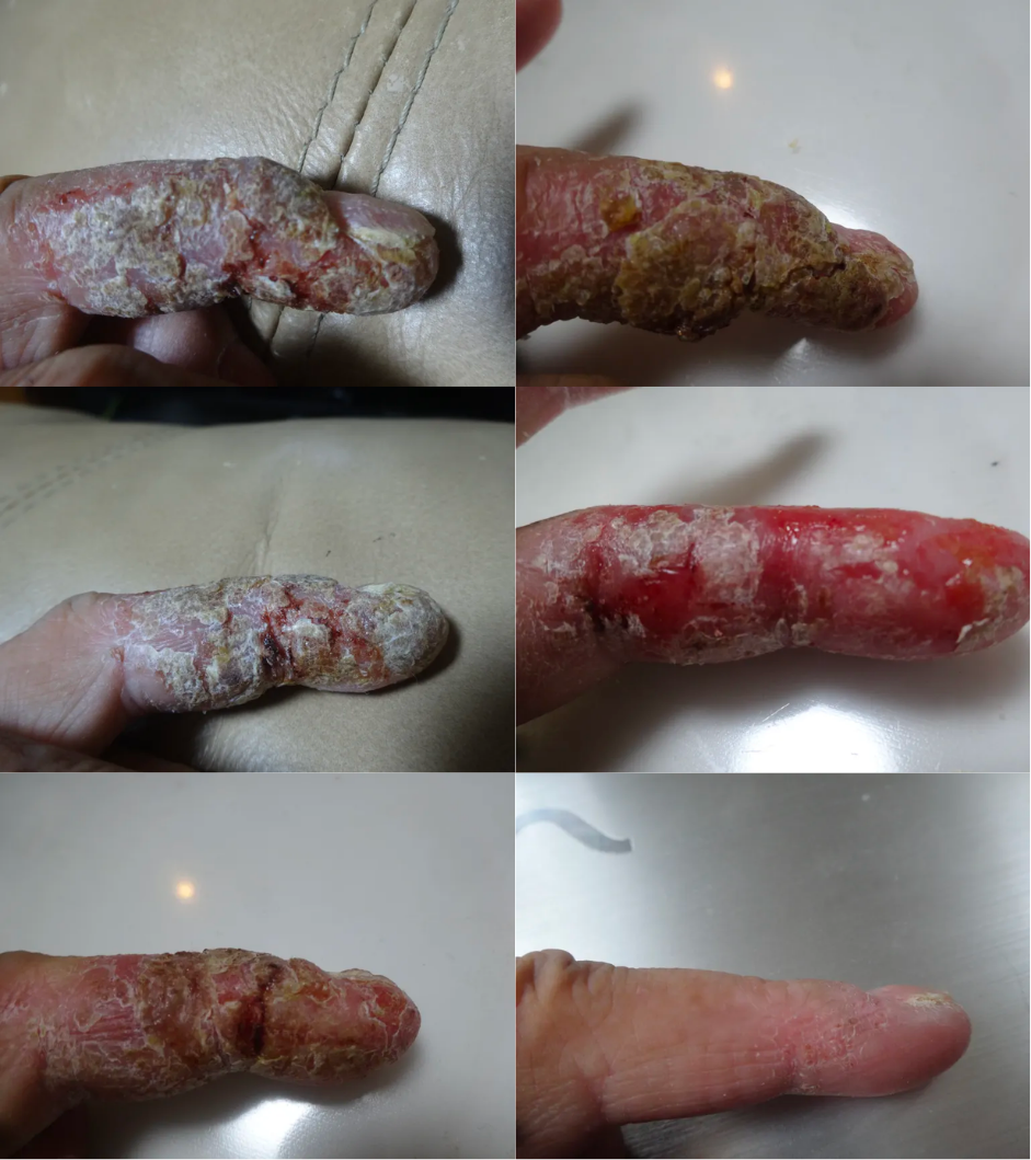 NMT no moisturiser treatment
