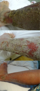 NMT no moisturiser treatment leg