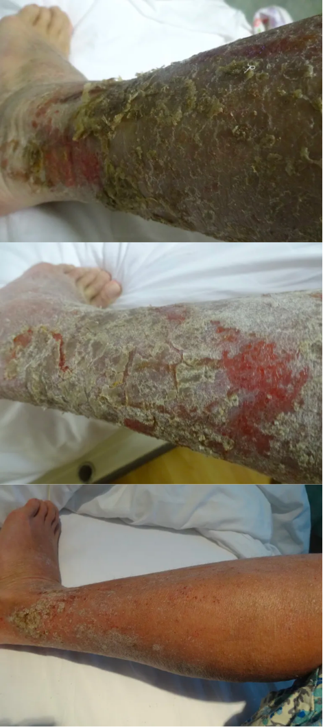 NMT no moisturiser treatment leg