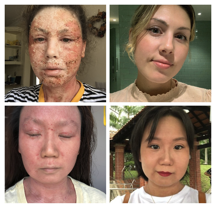 Jing Rui and Louise King Skin Solace skin solace cold atmospheric plasma