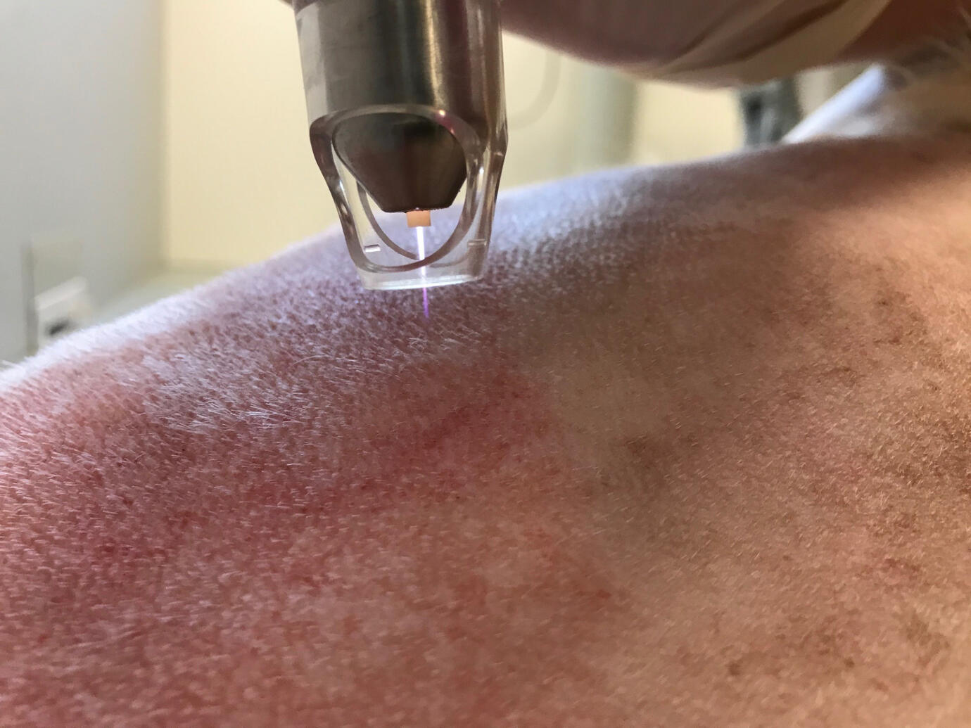 cold atmospheric plasma therapy