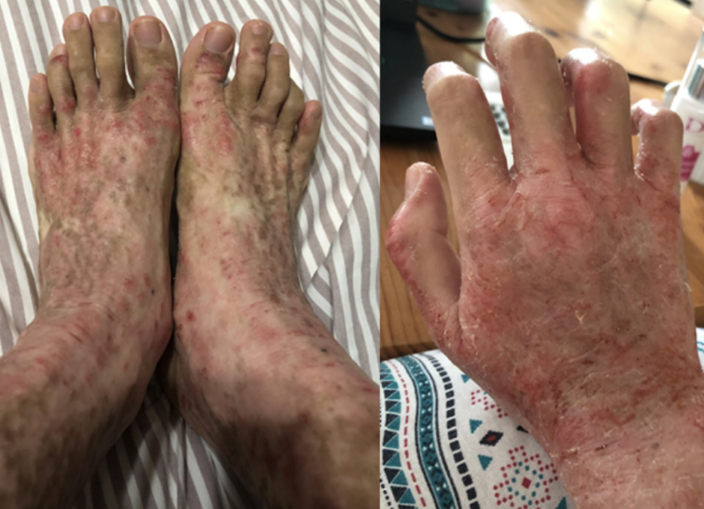 topical steroid withdrawal